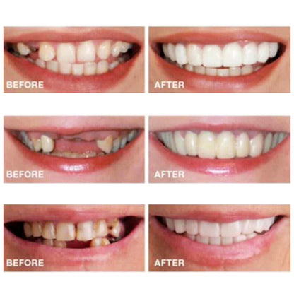 Cosmetic Denture Denture Denture False Teeth Artificial Teeth DE